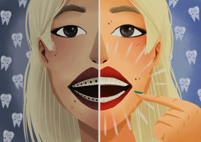 Illustration of a blonde woman wearing braces on half her smile and Invisalign on the other half to compare orthodontic treatments