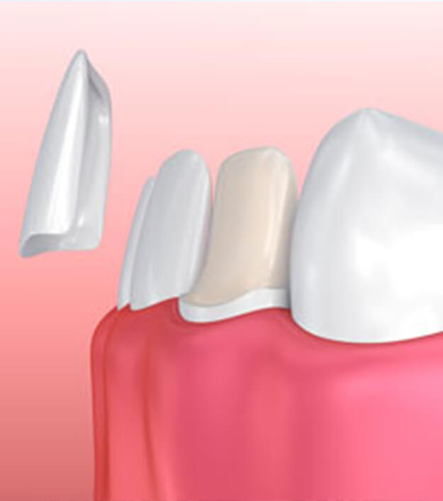 illustration of veneers