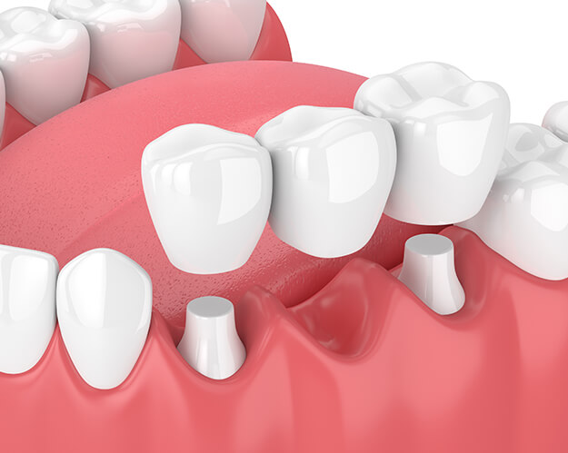 illustration of dental bridges