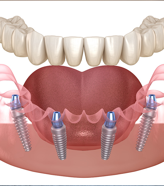 illustration of dentures
