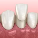 process for getting veneers, porcelain veneers, dental veneers, Caring Smiles Dental, Dr. Ankur Patel, Hoffman Estates IL dentist