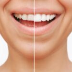 dental veneers, cosmetic dental treatments, Caring Smiles Dental, Hoffman Estates IL, veneers for gaps, veneers for stains, smile makeover, veneer benefits