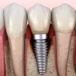 dental implant with peri-implantitis, periimplantitis