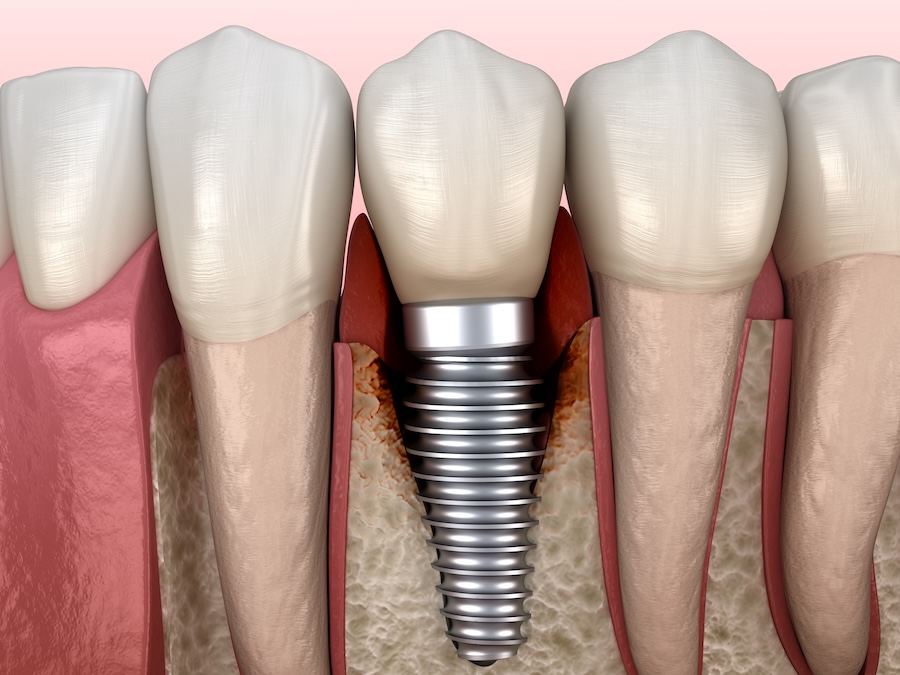 dental implant with peri-implantitis, periimplantitis